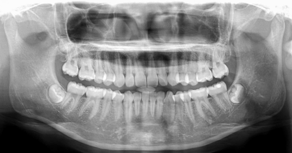 The Benefits Of Cone Beam X Ray Technology For Precise Dental Implants