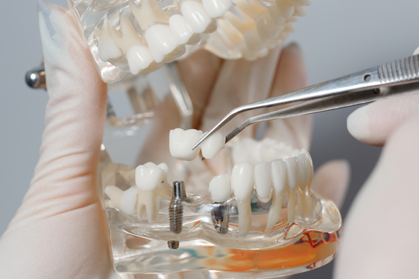 How A Dentist Uses Dental Implants To Replace A Missing Tooth