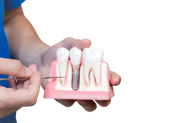An Oral Surgeon Breaks Down How Dental Implants Are Installed