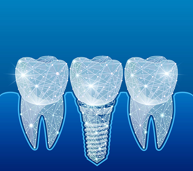 Coon Rapids Dental Implants