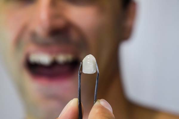 Tooth Replacement Options From An Oral Surgeon